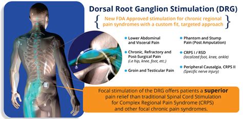 kulebra treatment|shingles dorsal root ganglion.
